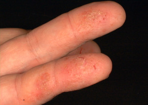 Example of allergic contact dermatitis