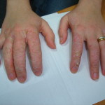 Example of allergic contact dermatitis