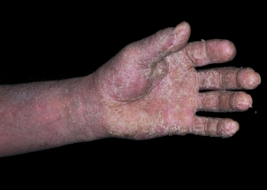 Example of contact dermatitis 