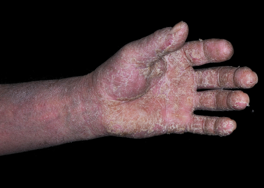 contact dermatitis wrist