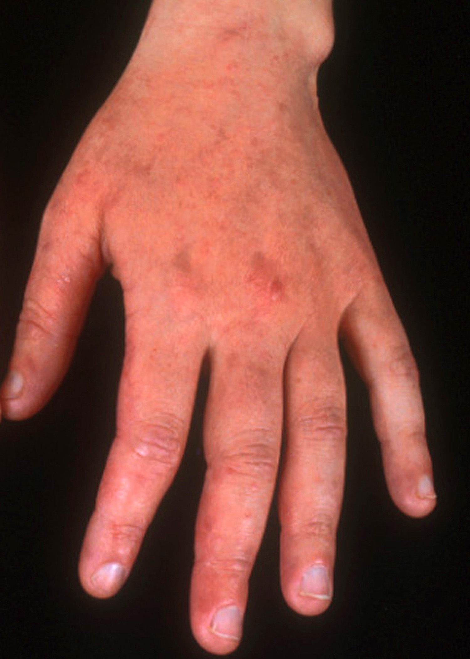 Irritant Contact Dermatitis Occupational Dermatology