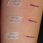 Example of positive prick test reactions 